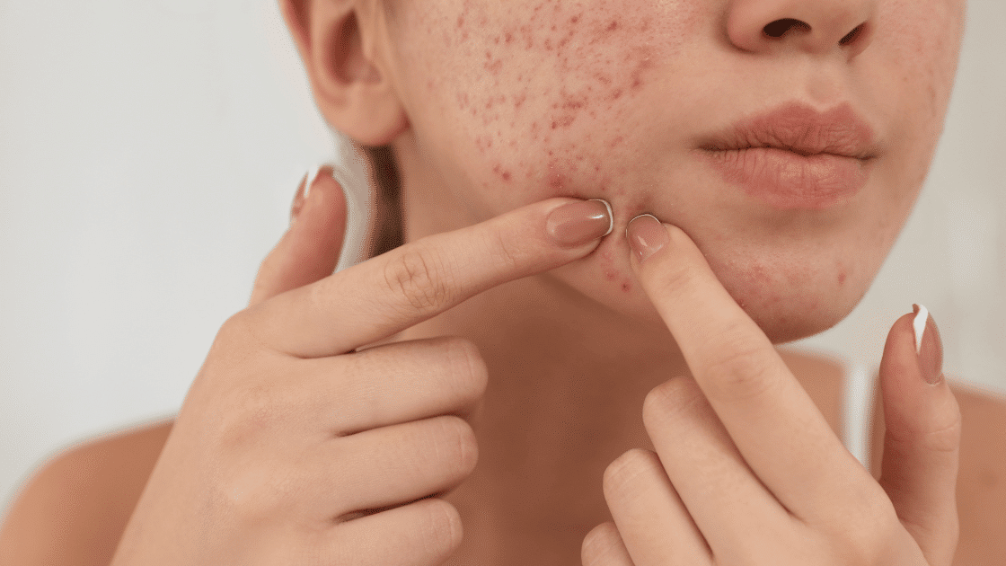 Understanding Acne Rosacea and Its Natural Treatment Approaches
